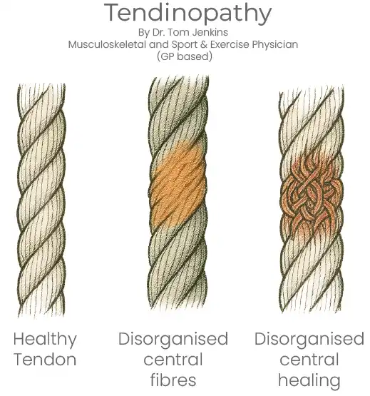 Rope analogy of tendinopathy